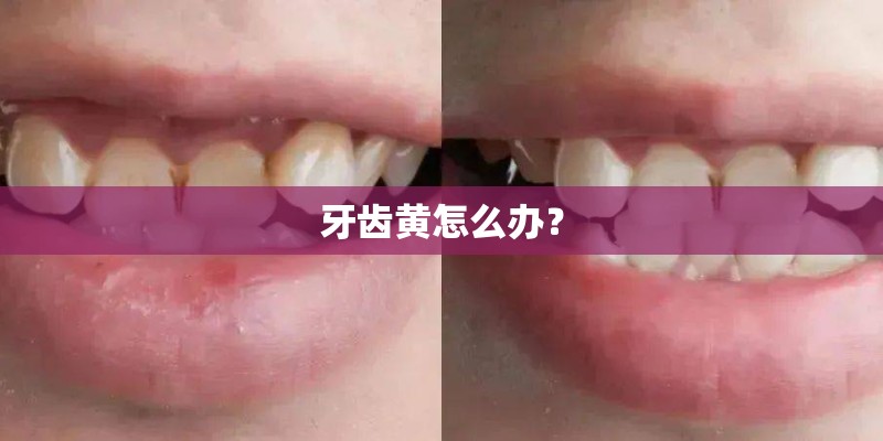 牙齿黄怎么办？