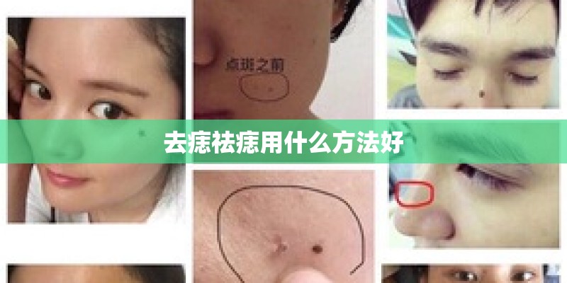 去痣祛痣用什么方法好