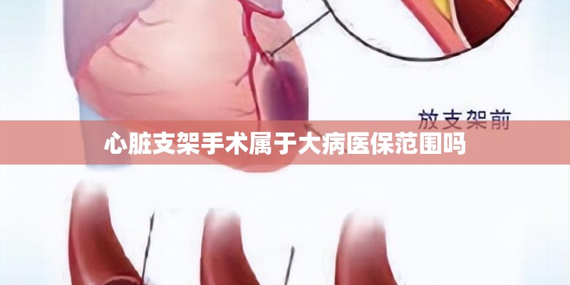心脏支架手术属于大病医保范围吗