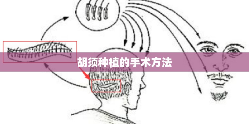 胡须种植的手术方法